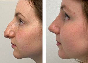 Understanding Rhinoplasty: What Is It
