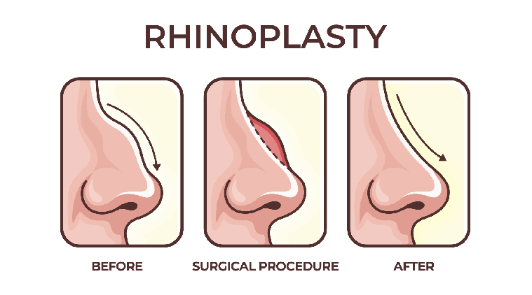 Rhinoplasty Procedures in Mumbai