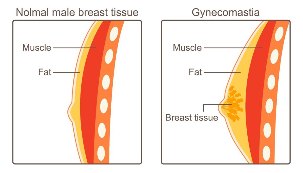 Trending Approaches in Gynecomastia Management