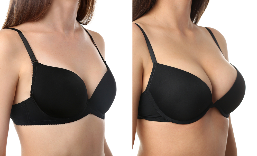Understanding Breast Augmentation