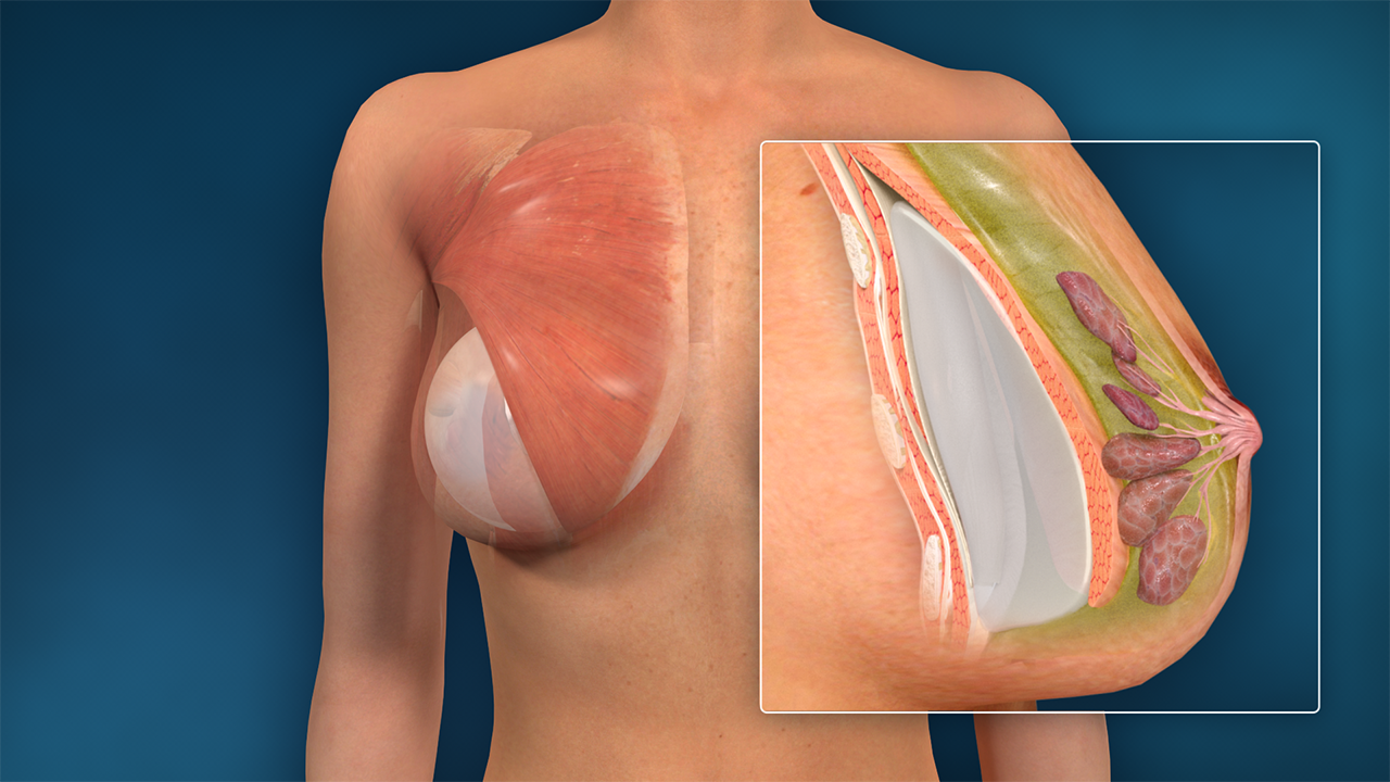 Breast Augmentation: Treatment Options and Best Practices