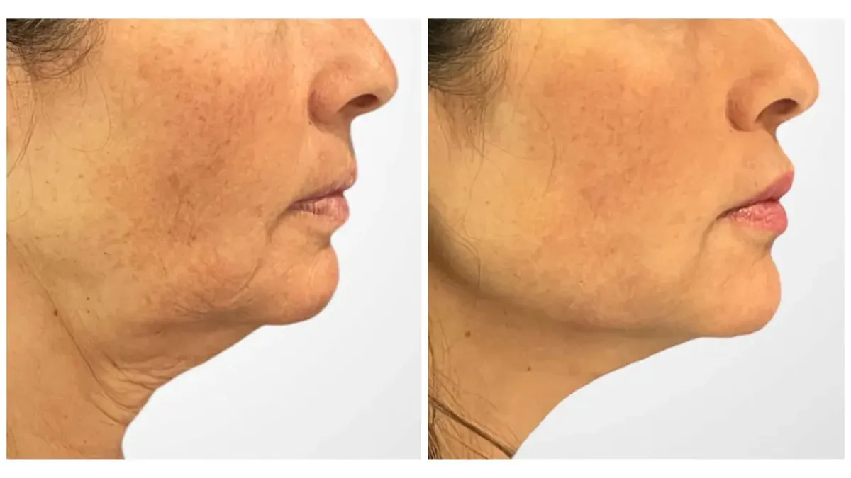 Facial and Neck Thread Lifting