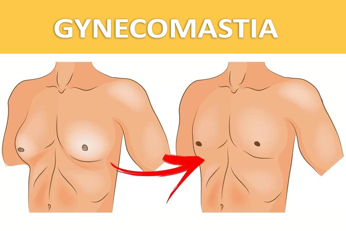 Understanding Gynecomastia surgery in Mumbai by Dr. Saumil Shah