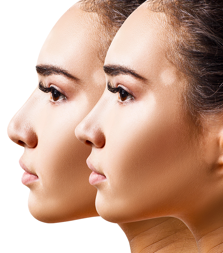 Rhinoplasty and the Healing Process
