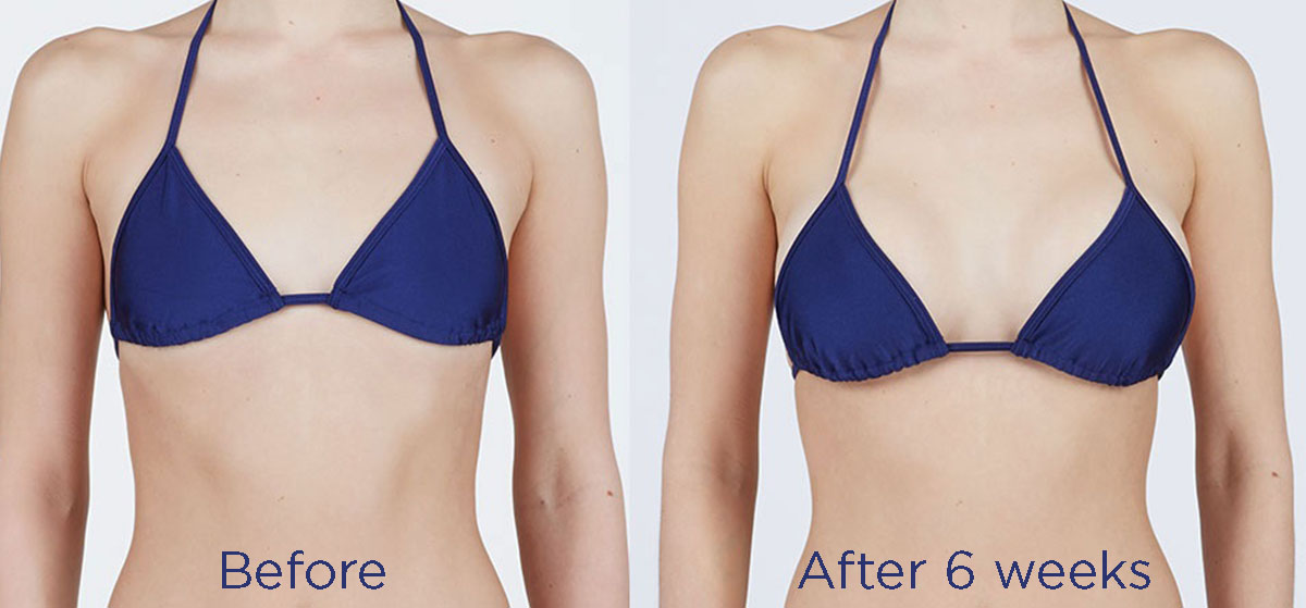 mini breast augmentation