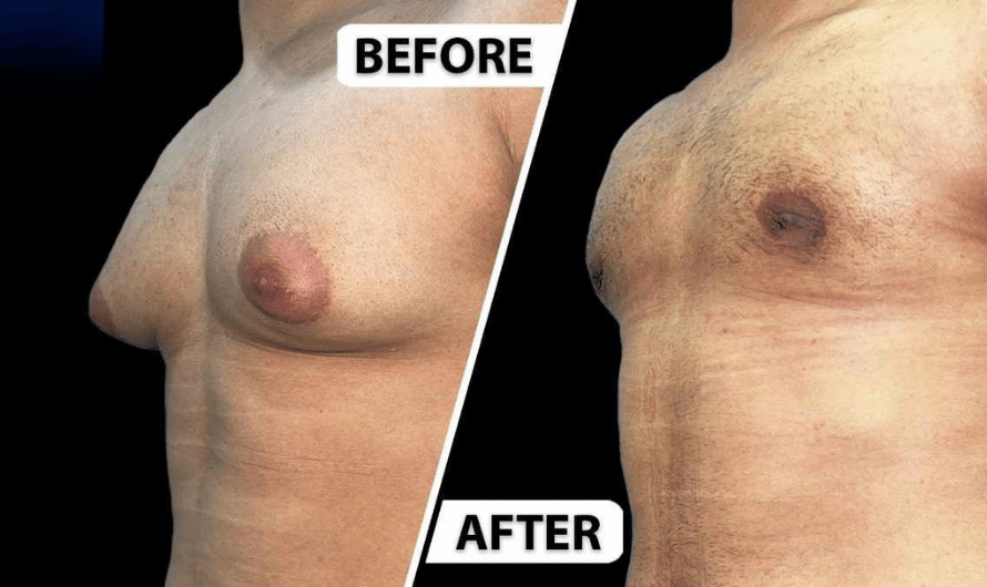 Scarless Gynecomastia Treatment in Mumbai