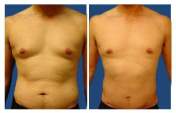What to Expect Before and After gyanomastia Surgery