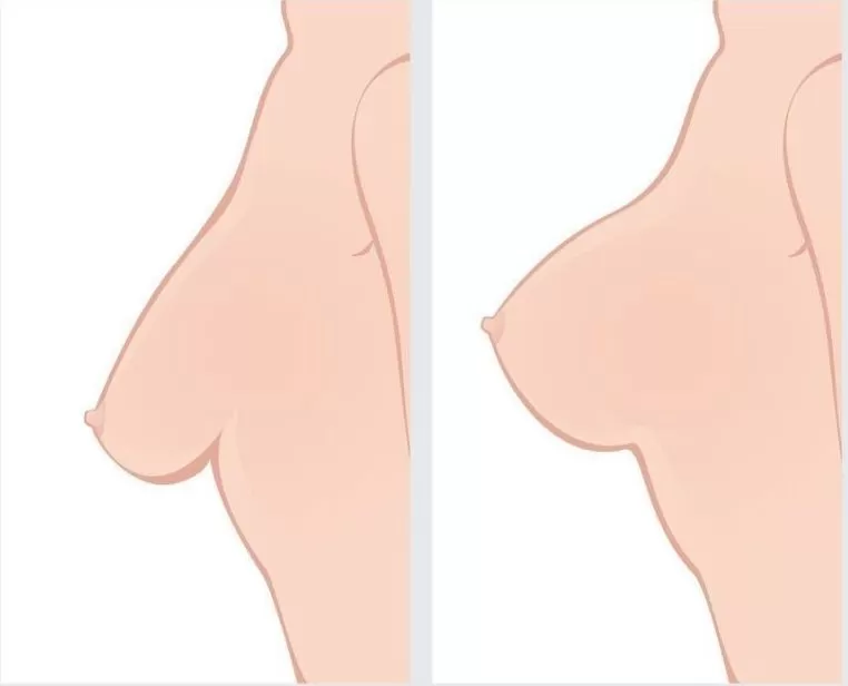 When Is a Breast Lift Needed With Implants?