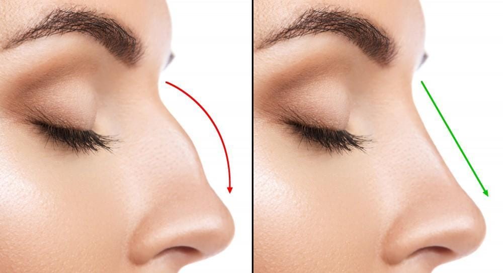 What to Expect During a Rhinoplasty Procedure