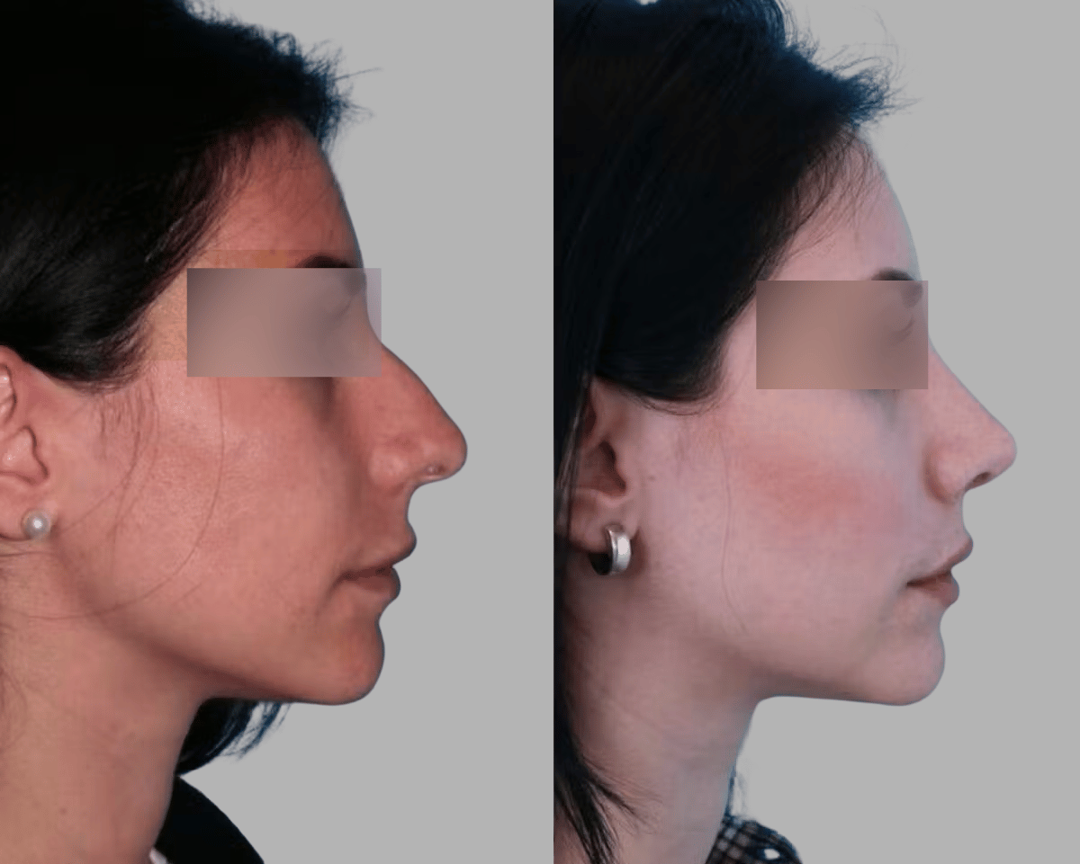 Understanding Celebrity Rhinoplasty Surgery in Mumbai