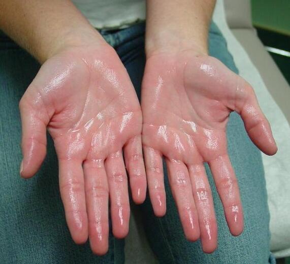 What Is Hyperhidrosis?