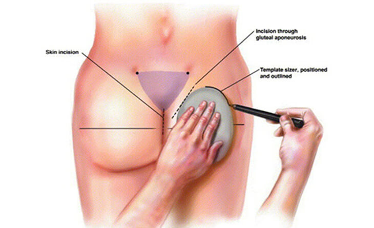 Safety of Buttock Implant Augmentation