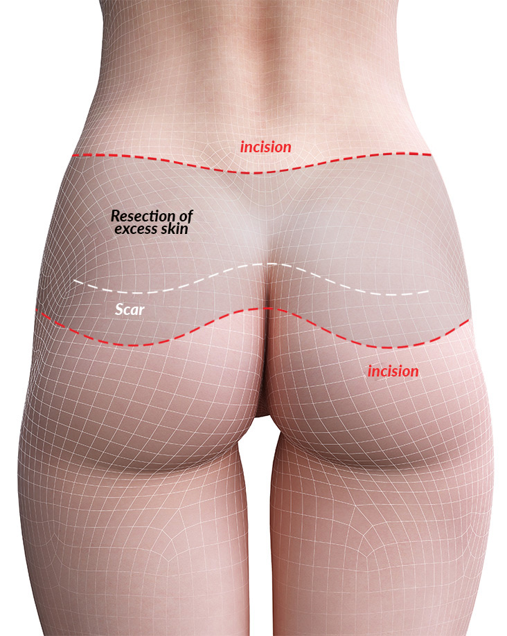 buttock procedure
