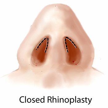 Closed Rhinoplasty
