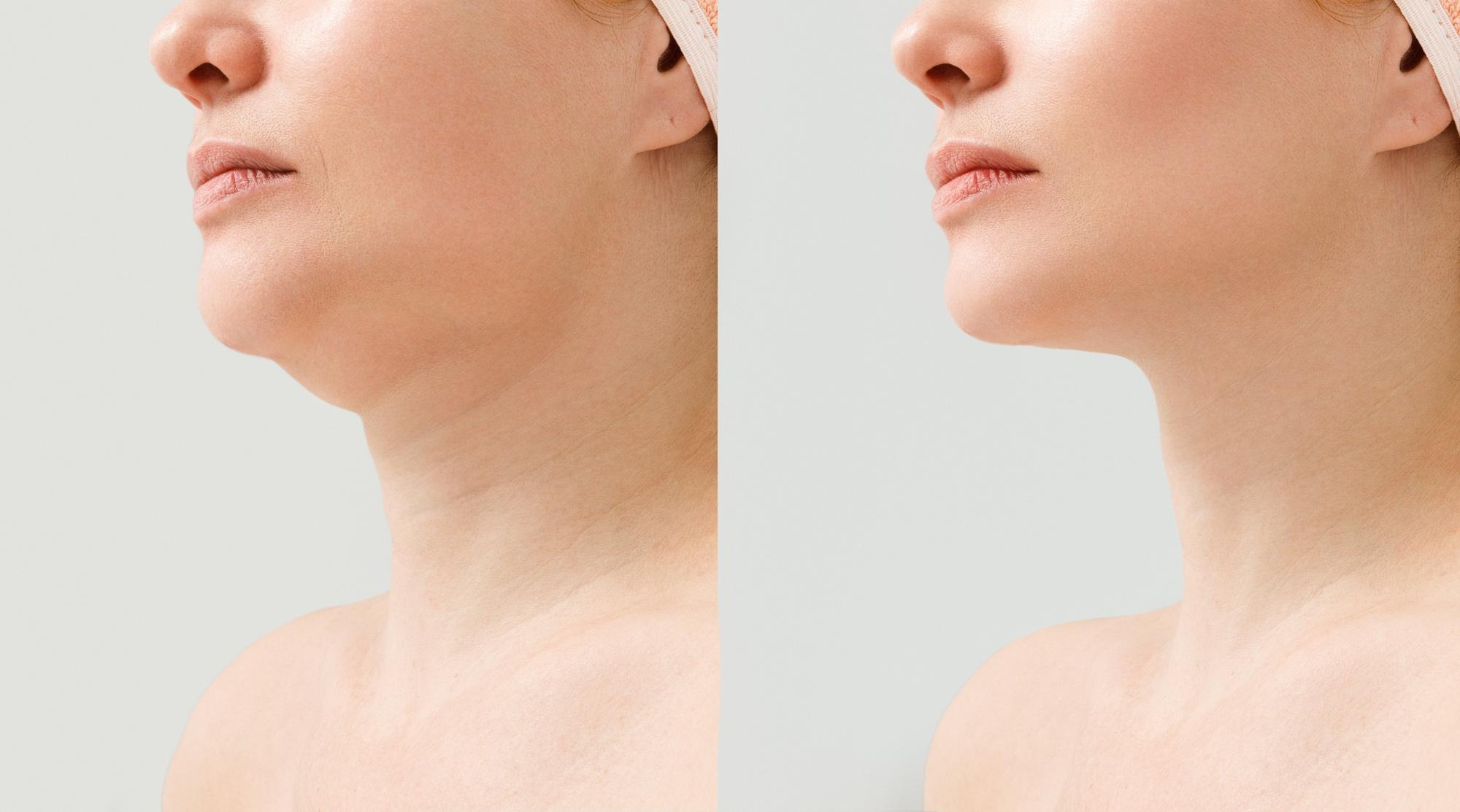 Treatment Options for Double Chin
