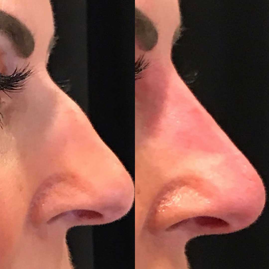 Non-Surgical Rhinoplasty