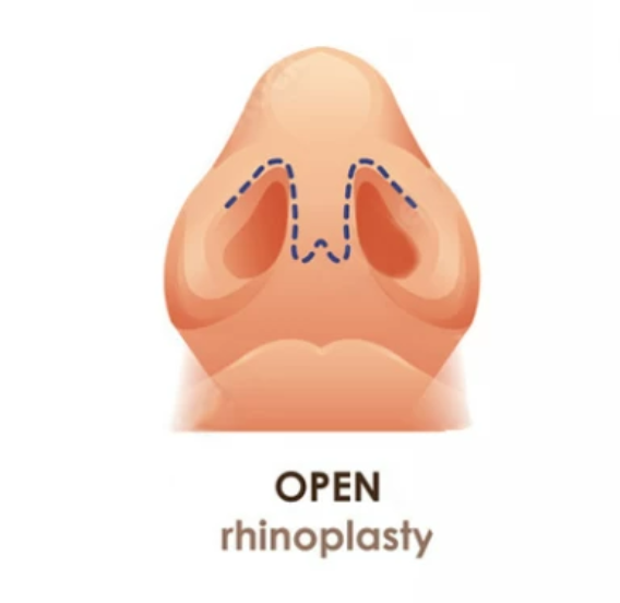 Open Rhinoplasty
