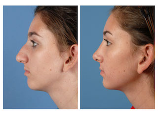 Before Your Rhinoplasty: What to Expect
