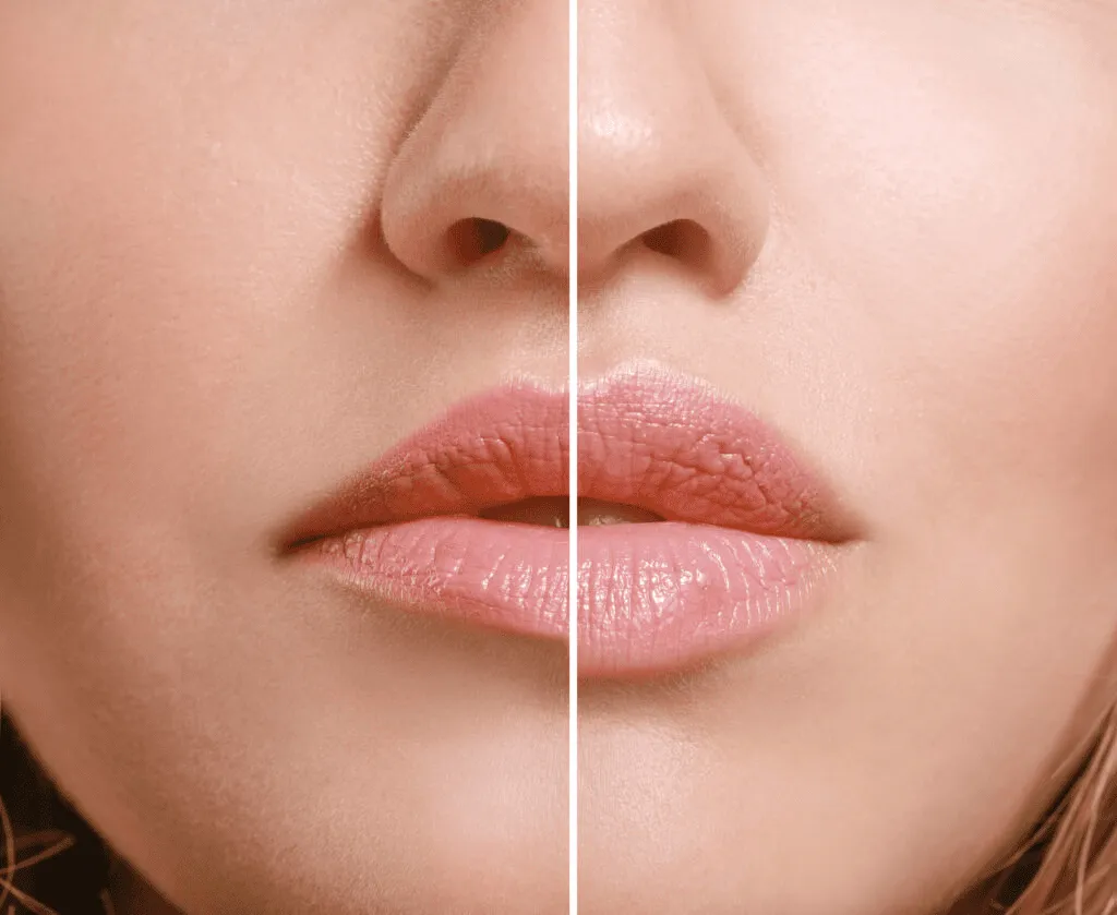 The Rise of Natural Lip Augmentation