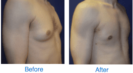 Understanding Gynecomastia
