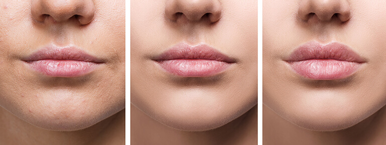 what-to-expect-from-lip-augmentation-procedure