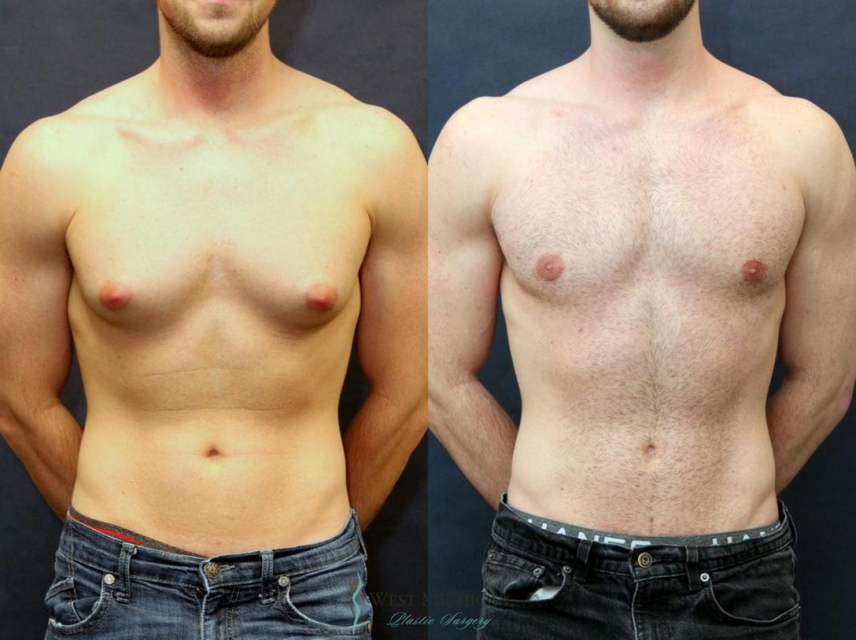 Gynecomastia surgery