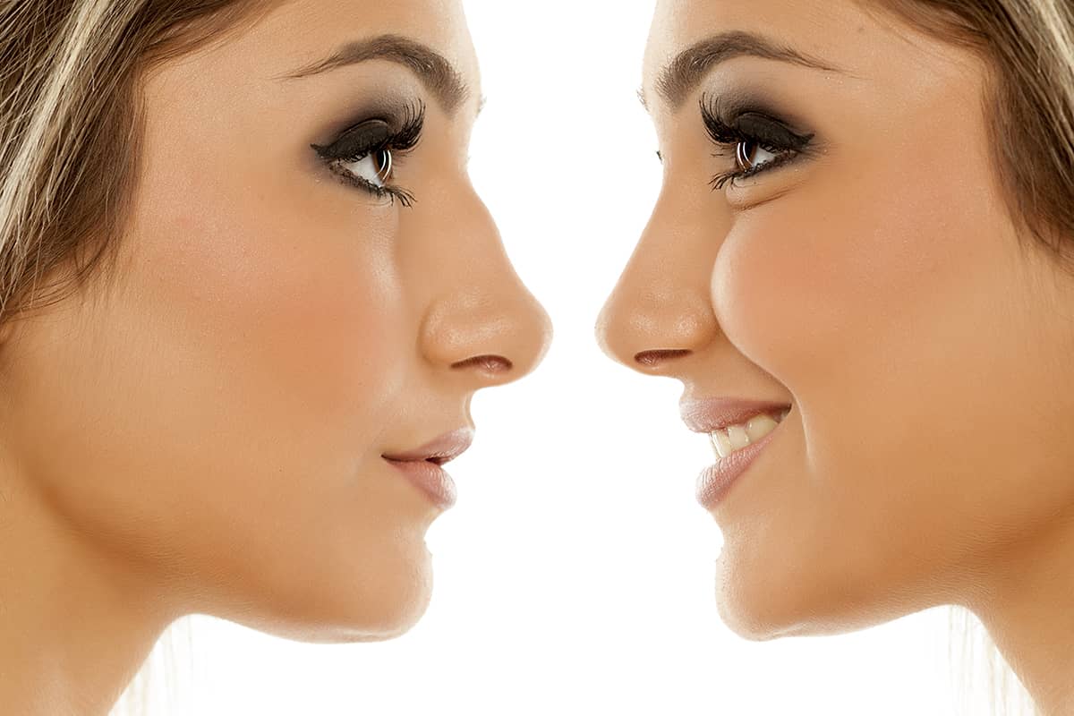 How Rhinoplasty Can Improve Appearance