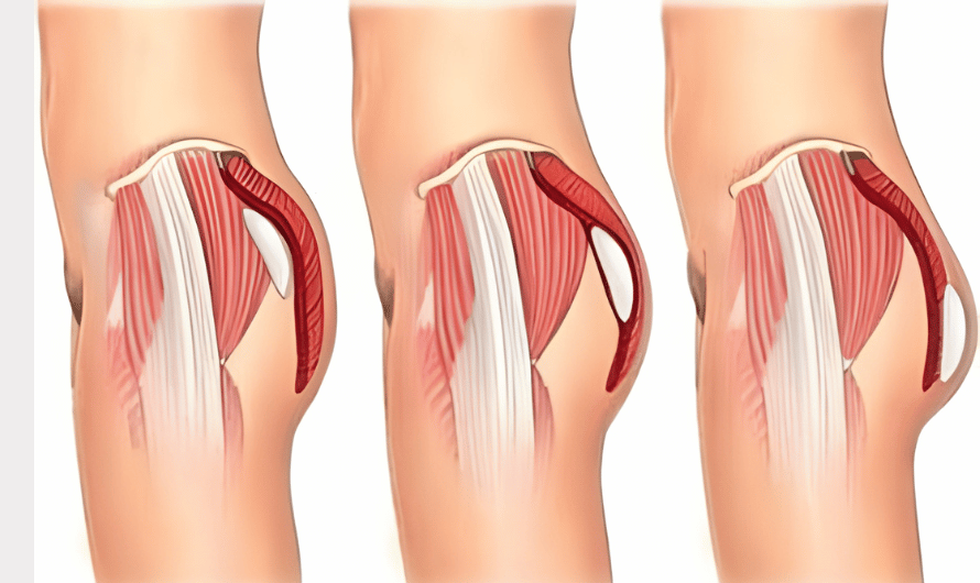 What Is Butt Augmentation?