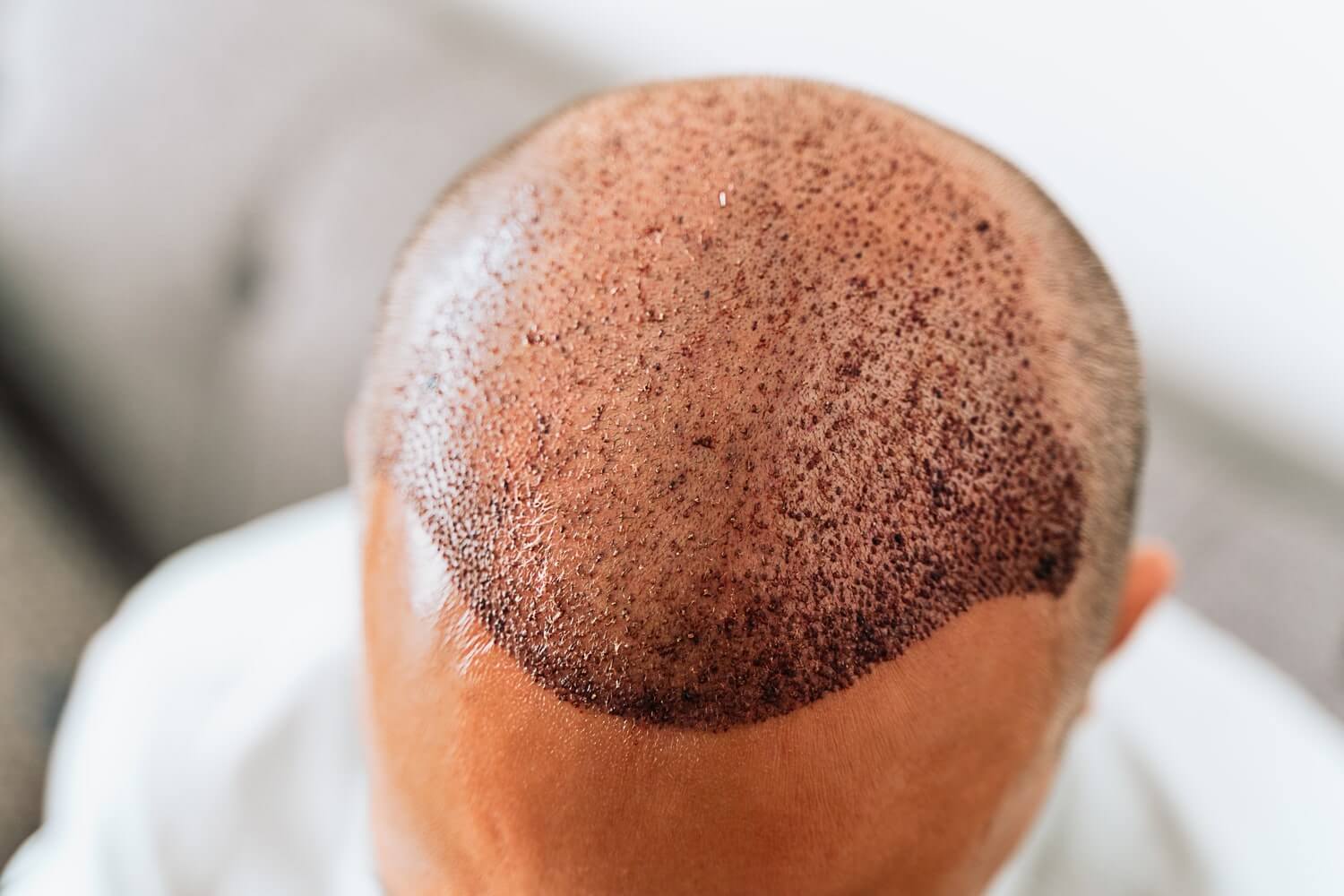 Tips from a Hair Transplant