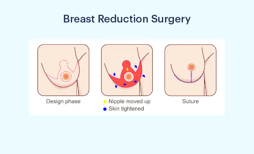 What Is Breast Reduction Surgery?