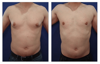Recovery After Gynecomastia Surgery