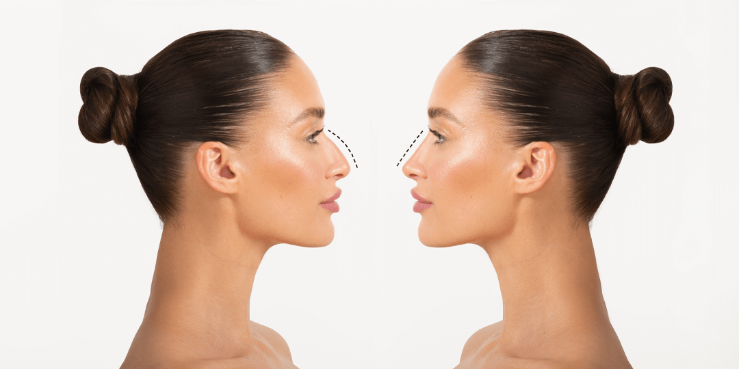 What Is a Deviated Nose and Why Should You Care?