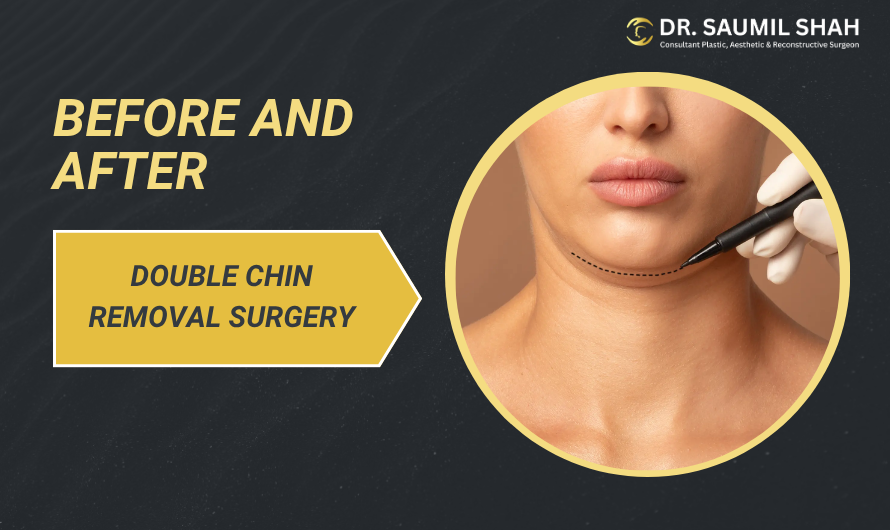 Double Chin Removal Surgery: What to Expect Before and After Treatment