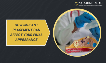 how-implant-placement-can-affect-your-final-appearance